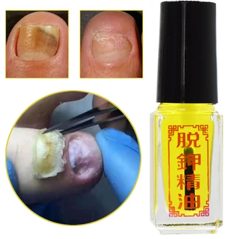 Китайската Медицина Противогрибковая Копър За Лечение на ноктите Избелване на Ноктите и Краката, Премахване на Гъбички на Ноктите На Краката е Грижа За Краката Гел За Нокти 30 мл
